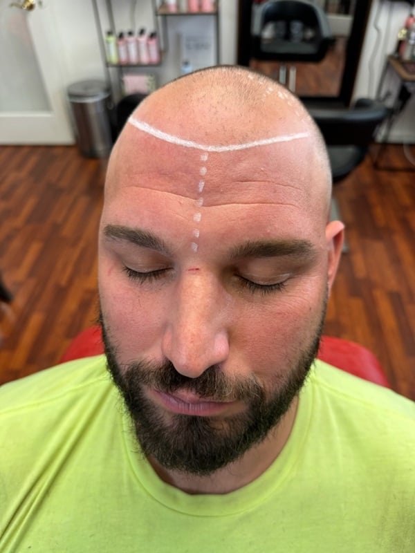 Hairline Design and Crown​